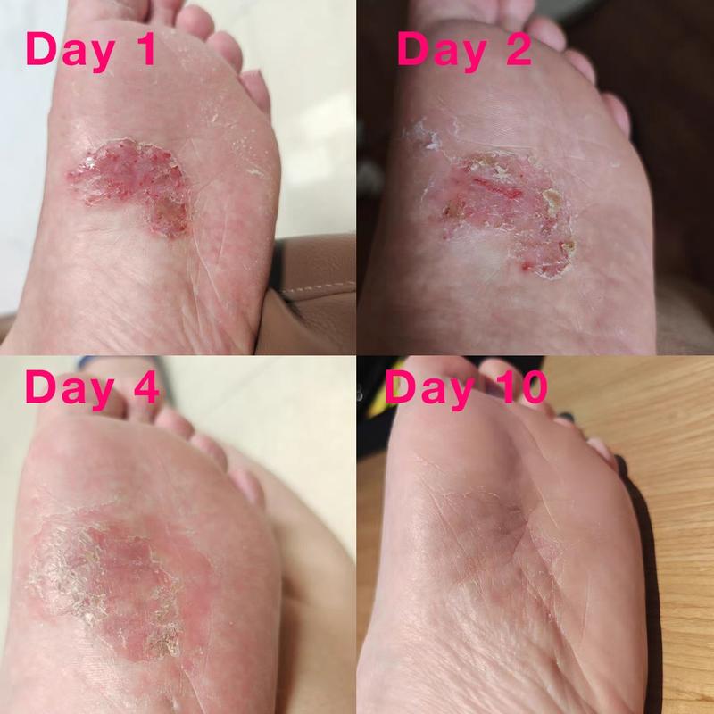 Tea Tree Oil Foot Sanitizer Spray for Dry Cracked Feet, Nail Fungus, Jock Itch, Ringworm, Cracked Heels, and Itchy Skin | Foot Spray