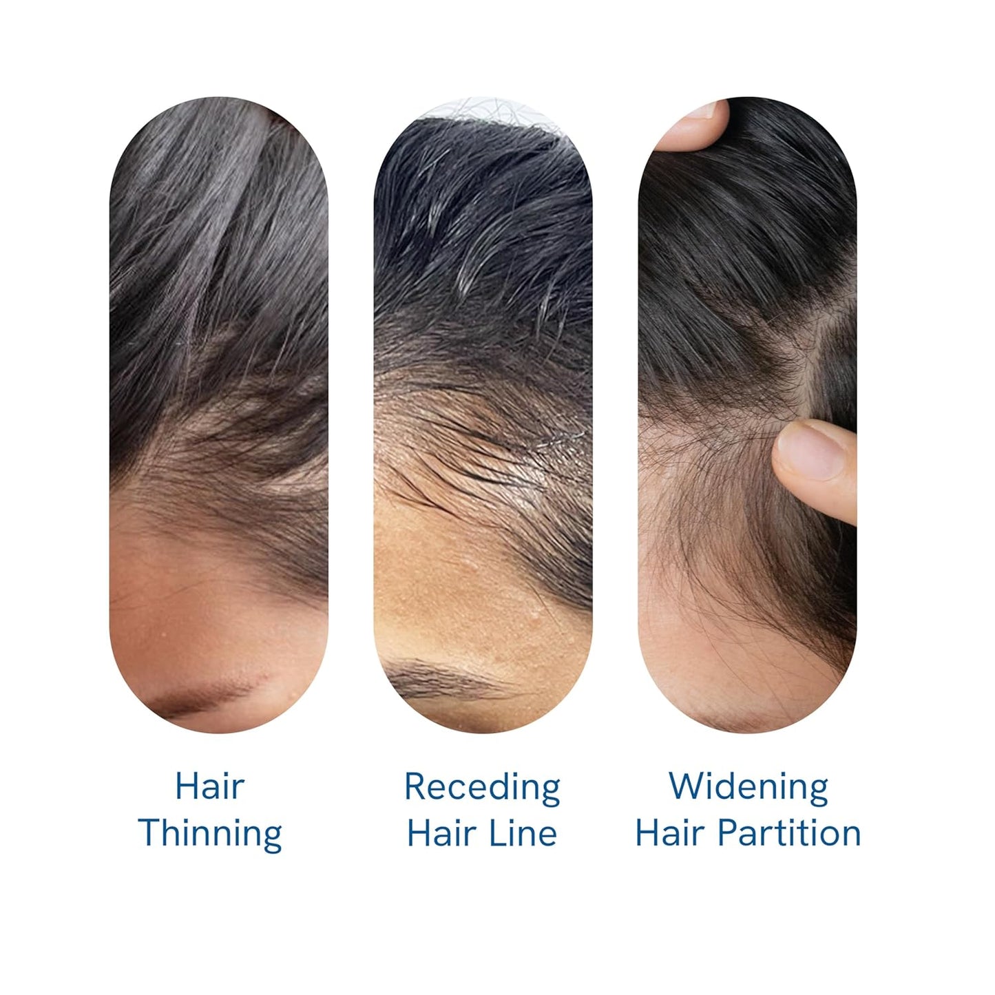 Be Bodywise Advanced Hair Growth Roll-On Serum | 3% Rosemary | 2% Aminexil | 3% Redensy l 2% Anagain | Precision Scalp Applicator | Paraben & Sulphate Free | Non oily and mess free