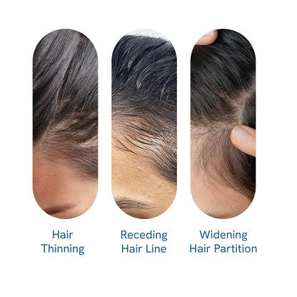 Be Bodywise Advanced Hair Growth Roll-On Serum | 3% Rosemary | 2% Aminexil | 3% Redensy l 2% Anagain | Precision Scalp Applicator | Paraben & Sulphate Free | Non oily and mess free