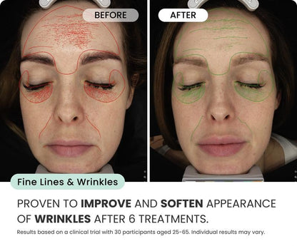 Micro-Infusion 2 Month Bundle (For Wrinkles + Dark Spots)